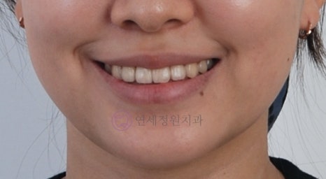 얼굴 비대칭과 치아 비대칭의 관계|치아 교정으로 개선할 수 있을까? 관련 이미지 8