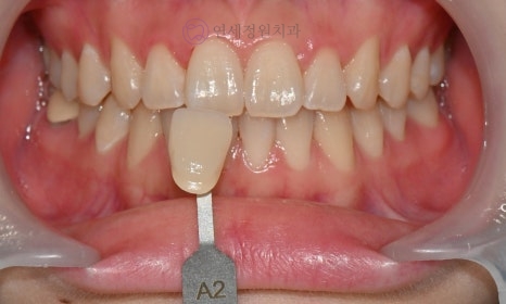 Precautions for Teeth Whitening Treatment @ Yonsei JW Dental Clinic 관련 이미지 10
