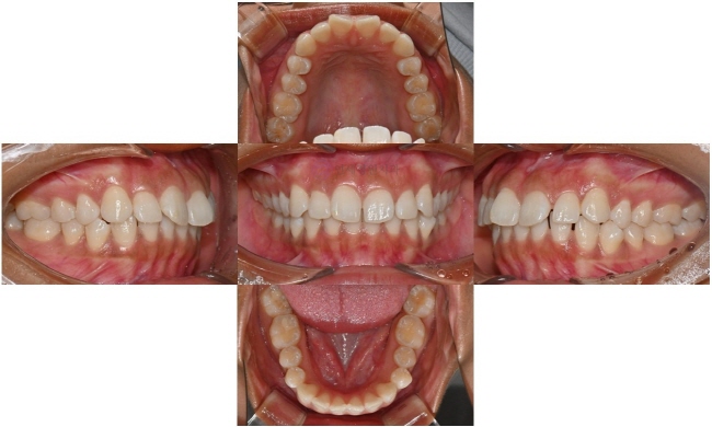 Invisalign Transfers for Immigration, Studying Abroad, Relocation, and More — International Students and Military Personnel image 2