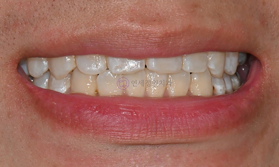 치아 미백 후 반점치의 아이콘 레진 치료 @ 대치동 연세정원치과 관련 이미지 8