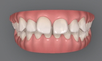 Invisalign Transfers for Immigration, Studying Abroad, Relocation, and More — International Students and Military Personnel image 3