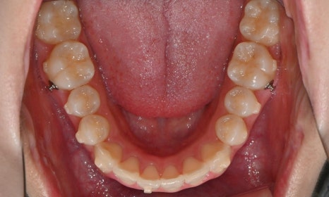 고등학생 인비절라인 교정｜앞니 치아배열 &middot; 과개교합 관련 이미지 16