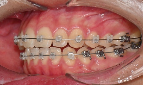 치아 중심선 비대칭과 아랫입술 돌출 개선 관련 이미지 10