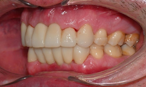 과개교합과 손상된 앞니, 심미와 기능을 함께 회복한 앞니 심미보철 케이스 관련 이미지 10