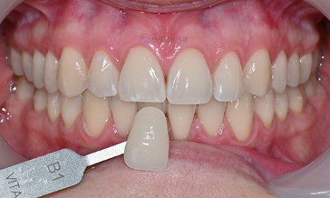 Teeth Whitening Case : A couple from the Netherlands 관련 이미지 11