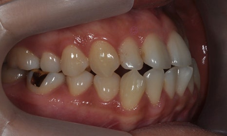 치아 중심선이 안 맞아요! 치아 비대칭 교정으로 가능할까요? @ 대치동 교정치과 연세정원치과 관련 이미지 16