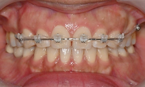 앞니 벌어짐 부분교정 (재교정) 관련 이미지 6