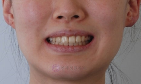 앞니가 안 물려요! 개방교합(openbite) 치아교정 전후 및 후기 관련 이미지 12