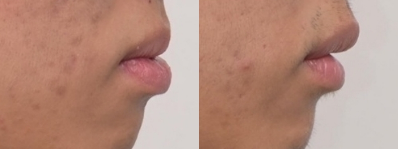 치아 중심선 비대칭과 아랫입술 돌출 개선 관련 이미지 27