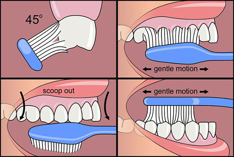치아교정시 양치법 및 구강위생관리 방법 관련 이미지 4