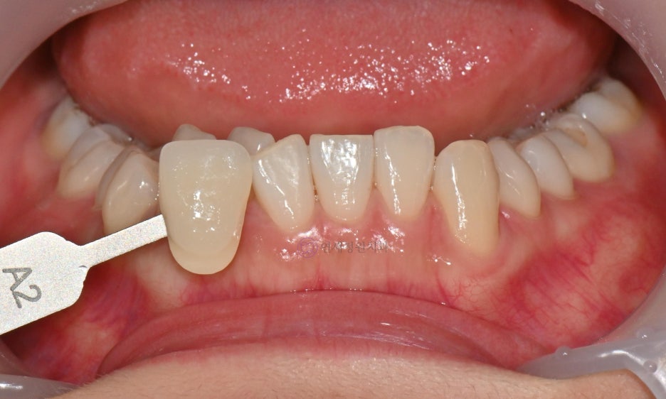 One Day Teeth Whitening Process @ Yonsei JW Dental Clinic 관련 이미지 9
