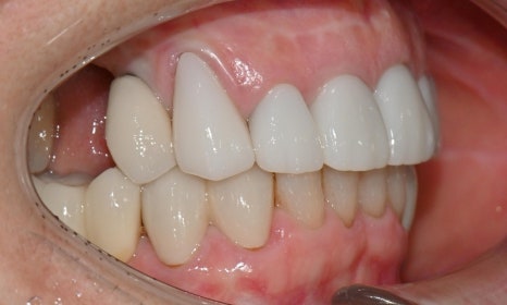 심미와 기능을 모두 고려한 앞니 심미보철 재치료 관련 이미지 9