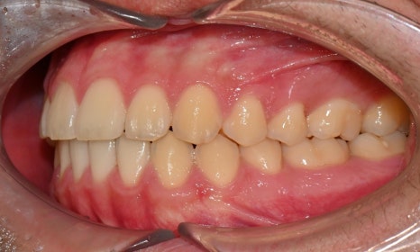 치아 중심선 비대칭과 아랫입술 돌출 개선 관련 이미지 20