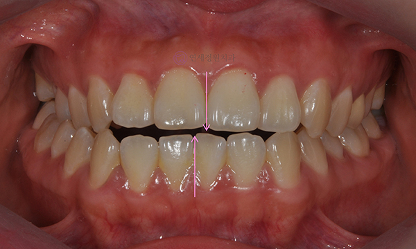 치아 중심선 비대칭 및 개방교합 교정, 대치동 연세정원치과 관련 이미지 4
