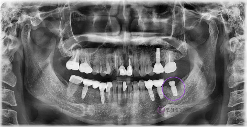 임플란트 1차 수술 vs 2차 수술 관련 이미지 7