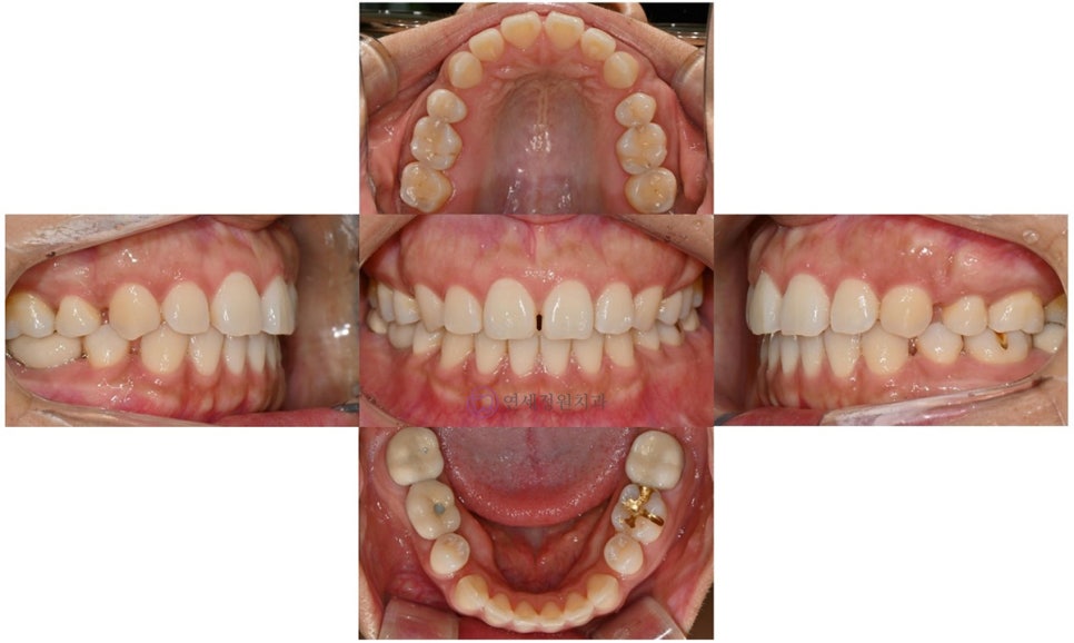 앞니 벌어짐 부분교정 (재교정) 관련 이미지 2