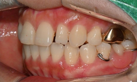 왜소치 치료 - 라미네이트 vs 레진비니어 vs 치아교정 관련 이미지 13