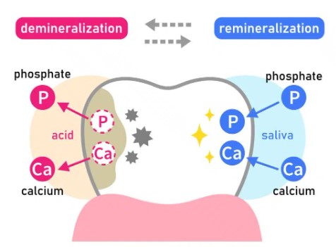 교정 치료 후 치아 미백 관련 이미지 6