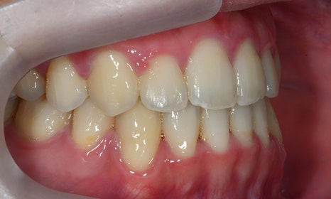 비대칭 및 돌출입 치아교정, 대치동 교정치과 연세정원치과 관련 이미지 17