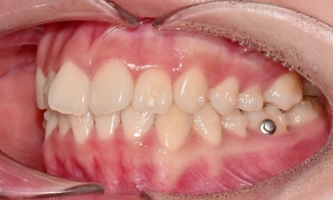 고등학생 인비절라인 교정｜앞니 치아배열 &middot; 과개교합 관련 이미지 9
