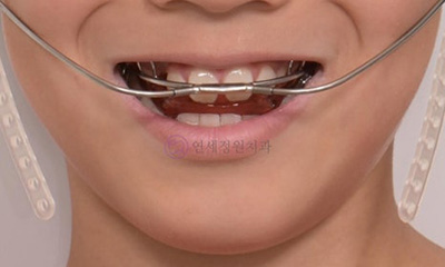 대치동교정치과, 무턱 성장교정과 엑티베이터 관련 이미지 5