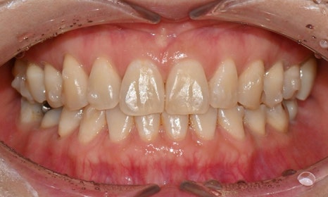 Teeth Whitening After Orthodontic Treatment at Yonsei JW Dental Clinic image 10