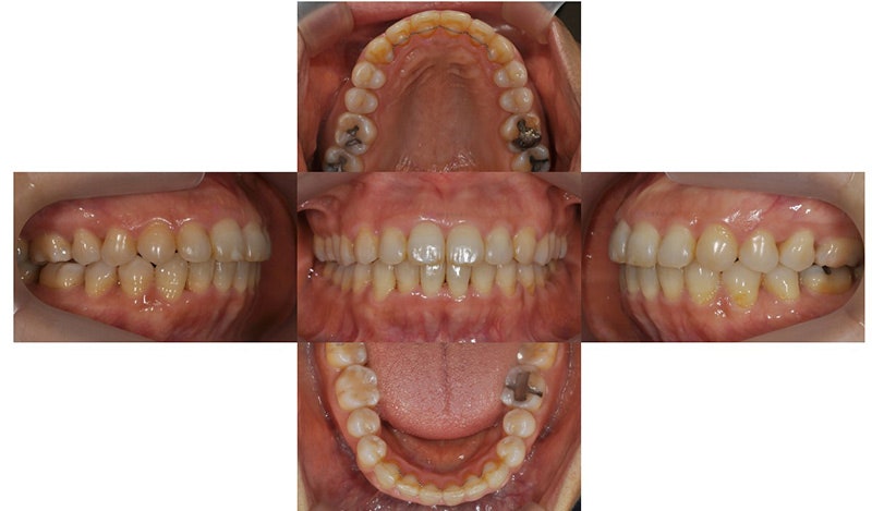 중년의 치아교정 시 고려할 사항, 대치동 연세정원치과 관련 이미지 3