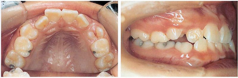 소아교정의 중요성 : 적절한 시기에 유치를 빼주는 것이 중요한 이유 @ 대치동 교정치과 연세정원치과 관련 이미지 12