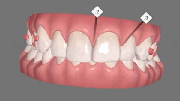 무삭제 라미네이트 vs 인비절라인 익스프레스 관련 이미지 7