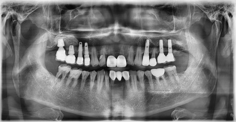 임플란트 1차 수술 vs 2차 수술 관련 이미지 4