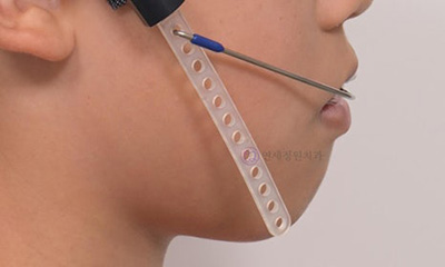 대치동교정치과, 무턱 성장교정과 엑티베이터 관련 이미지 6