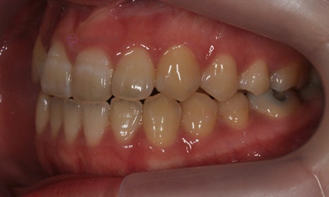 치아 중심선이 안 맞아요! 치아 비대칭 교정으로 가능할까요? @ 대치동 교정치과 연세정원치과 관련 이미지 23