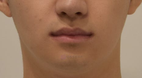 비대칭 및 돌출입 치아교정, 대치동 교정치과 연세정원치과 관련 이미지 9