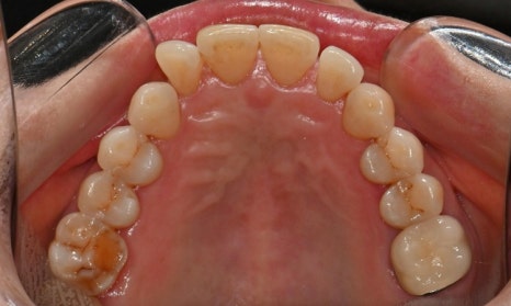 대치동 치경부 레진 & 중년교정 & 치아미백으로 자연스러운 미소를! 관련 이미지 5