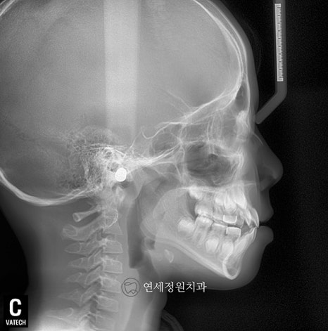 유학생 치아교정, 인비절라인 연세정원치과 관련 이미지 7