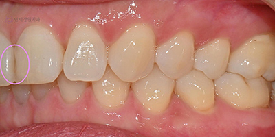 Dental Bonding for Gaps Between Front Teeth & Black Triangles | Gangnam, Seoul 관련 이미지 11
