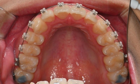 치아 중심선 비대칭과 아랫입술 돌출 개선 관련 이미지 11