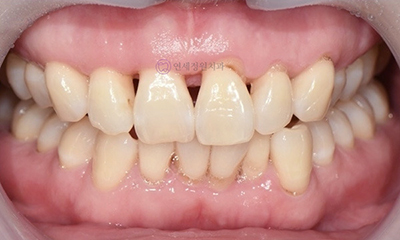 Front Tooth Resin Treatment in Korea: Microdontia, Gaps & Black Triangles 관련 이미지 12