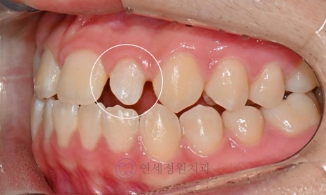 왜소치 치료 - 라미네이트 vs 레진비니어 vs 치아교정 관련 이미지 4