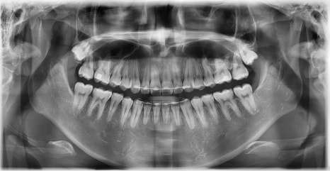 치아 중심선 비대칭과 아랫입술 돌출 개선 관련 이미지 24