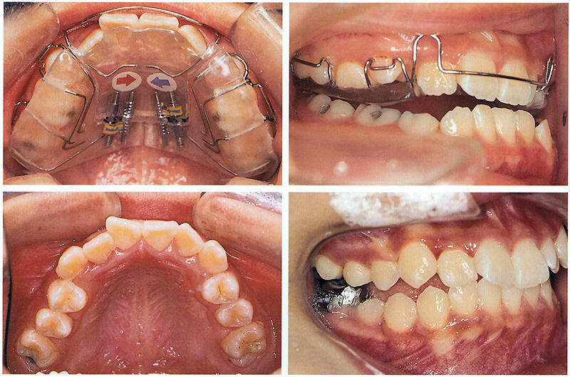 소아교정의 중요성 : 적절한 시기에 유치를 빼주는 것이 중요한 이유 @ 대치동 교정치과 연세정원치과 관련 이미지 13