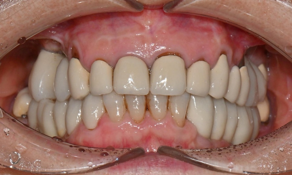 심미와 기능을 모두 고려한 앞니 심미보철 재치료 관련 이미지 3