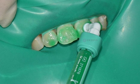 White Spot on My Front Tooth: Cavity or White Spot Lesion? 관련 이미지 6