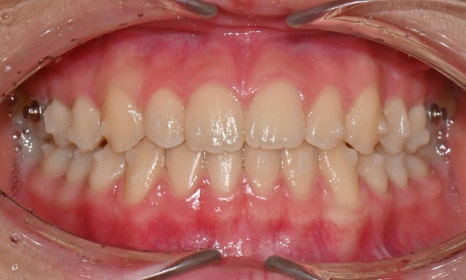 어린이 주걱턱, 페이스 마스크 성장교정 후 인비절라인 관련 이미지 12