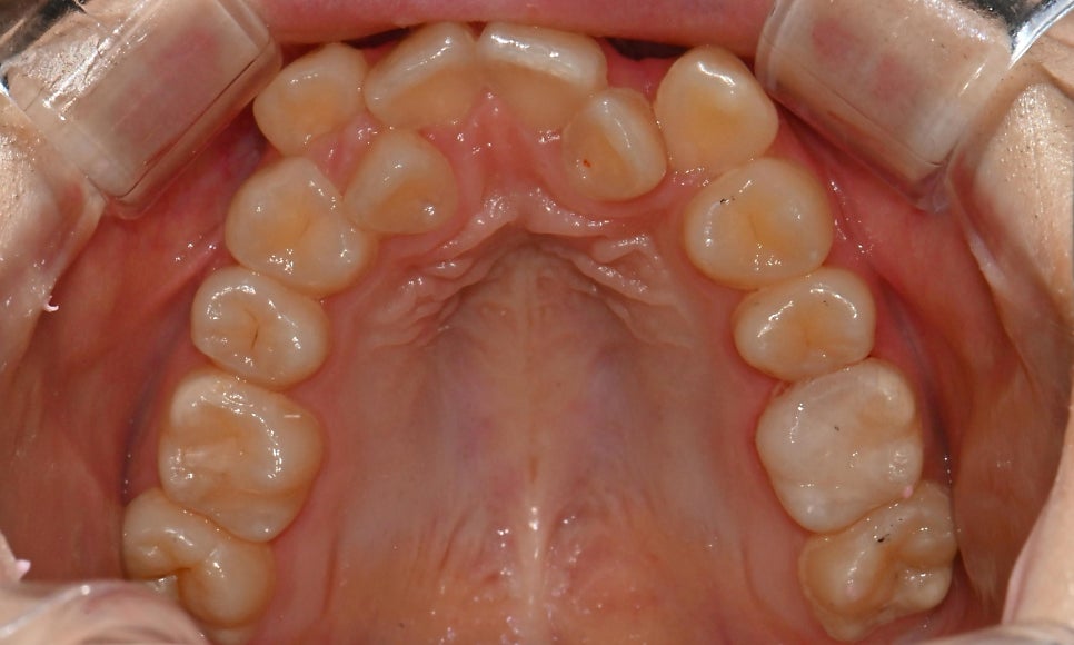 악궁확장장치(RPE, MARPE, MSE) 돌리는 방법 관련 이미지 2