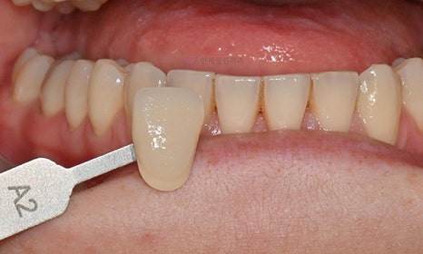 원데이 치아미백 @ 대치동치과 연세정원치과 관련 이미지 10