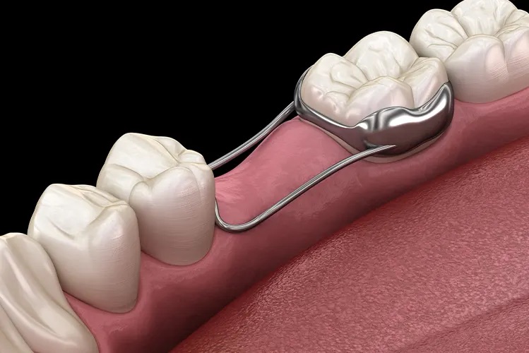 유치가 빨리 빠졌어요, 대치동소아치과 연세정원치과 관련 이미지 3