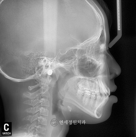 유학생 치아교정, 인비절라인 연세정원치과 관련 이미지 9