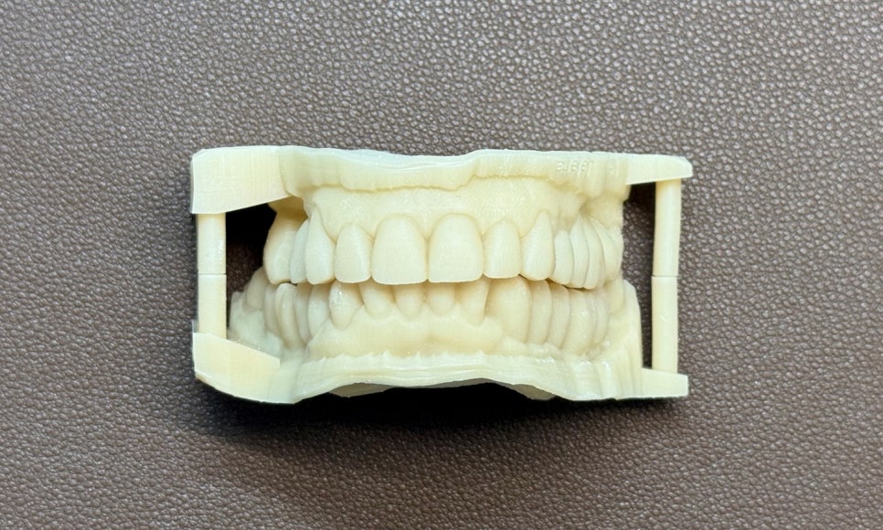 심미와 기능을 모두 고려한 앞니 심미보철 재치료 관련 이미지 7