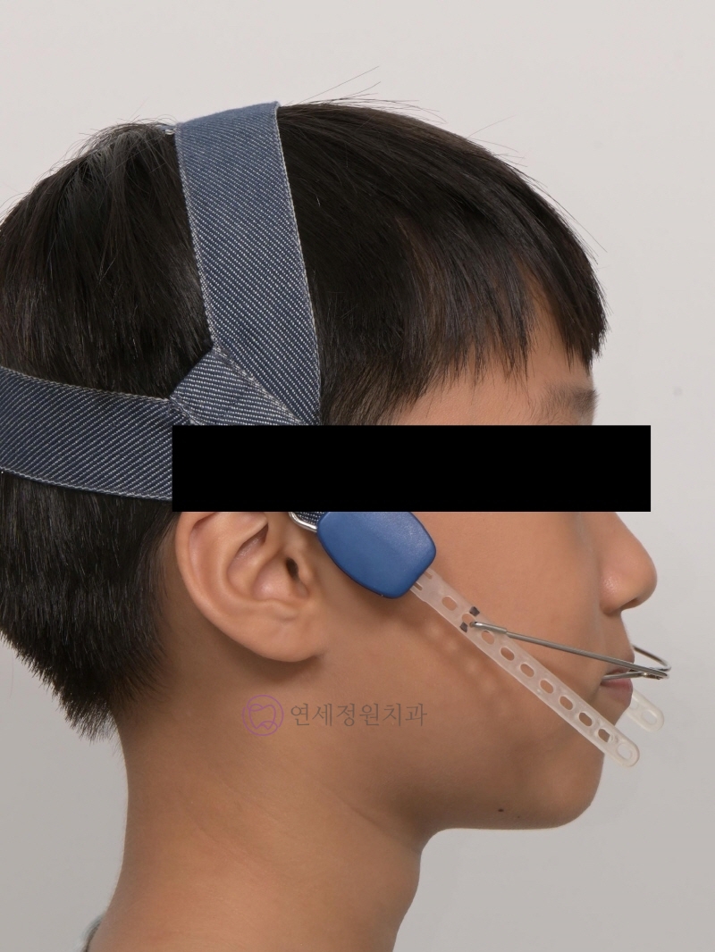 성장기 무턱교정 인비절라인 MA(mandibular advancment) 관련 이미지 3